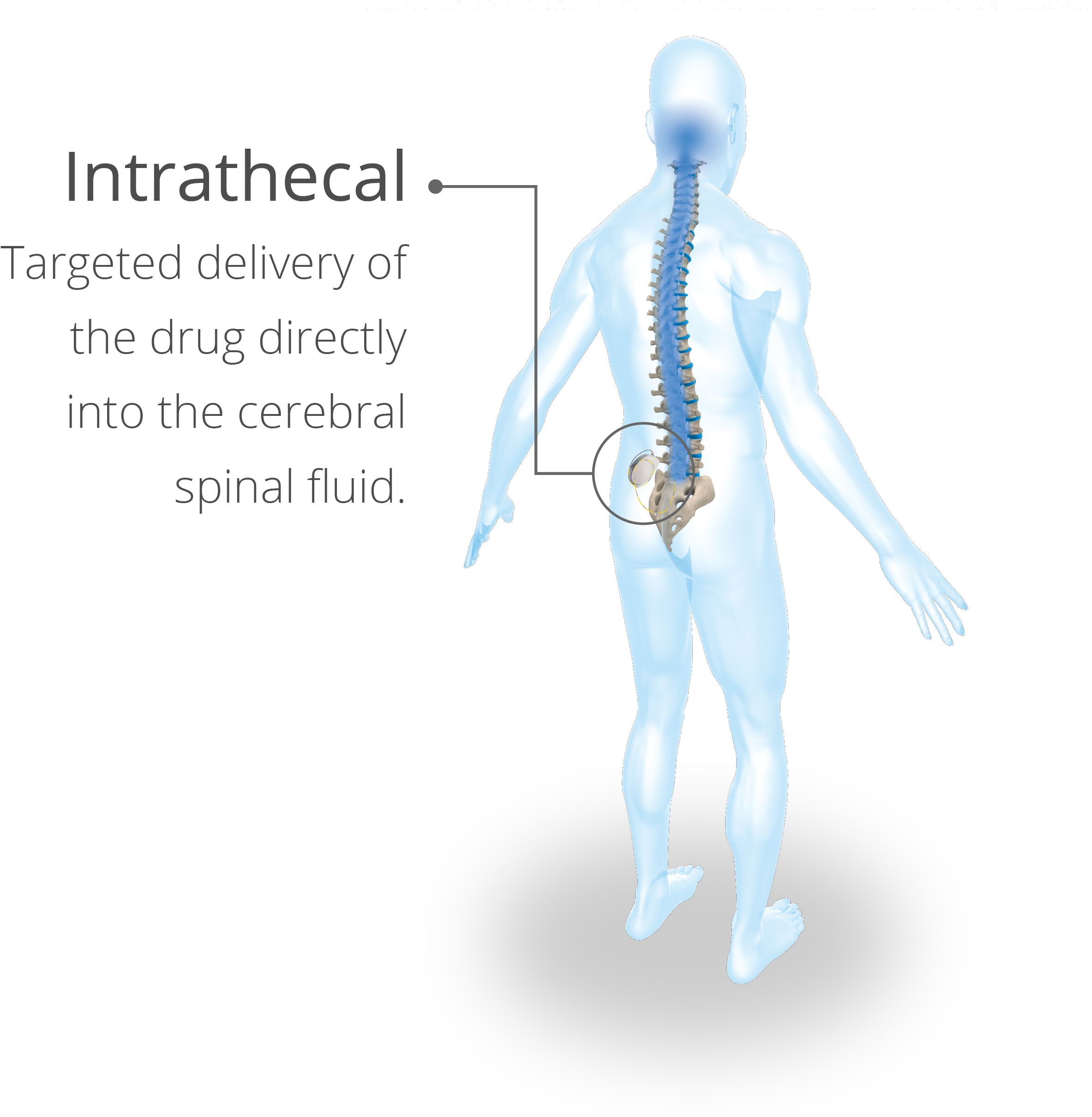 graphic illustrating the intrathecal use of Lioresal®, showing direct delivery to the spinal cord.