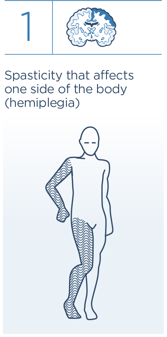 1 Spasticity that affects one side of the body (hemiplegia)