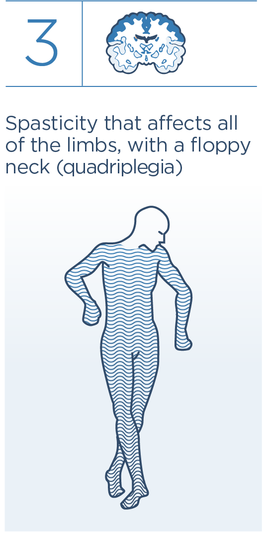 3 Spasticity that affects all of the limbs, with a floppy neck (quadriplegia)